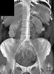 Renal Cell Carcinoma - CTisus CT Scan