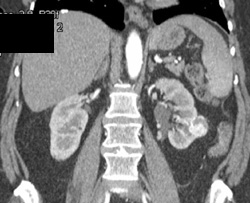 Renal Cell Carcinoma - CTisus CT Scan