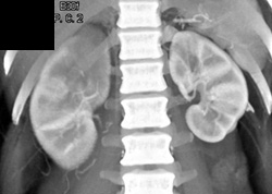 Transitional Cell Carcinoma of Right Kidney - CTisus CT Scan