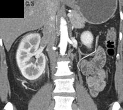 Tumor Extends Into the Renal Vein and IVC - CTisus CT Scan