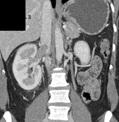 Transitional Cell Carcinoma Extends Into Renal Vein and IVC - CTisus CT Scan