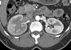 Inferior Vena Cava (IVC) Clot - CTisus CT Scan