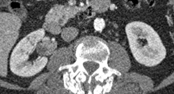 Transitional Cell Carcinoma - CTisus CT Scan