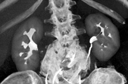 Normal CT Urogram - CTisus CT Scan