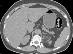 Renal Angiomyolipoma (AML) - CTisus CT Scan