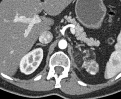 Renal Angiomyolipoma (AML) - CTisus CT Scan