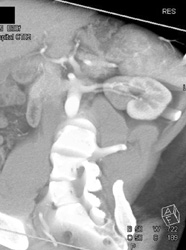 Prehilar Branching on Left - CTisus CT Scan