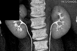 Normal CT Urogram - CTisus CT Scan