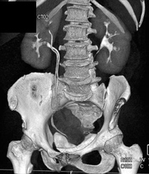 Ct Urogram With Duplicated System on Right - CTisus CT Scan