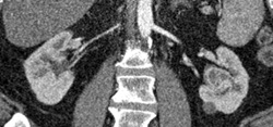 Renal Carcinoma - CTisus CT Scan