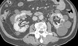 Renal Cysts and Fatty Infiltration of the Pelvis - CTisus CT Scan