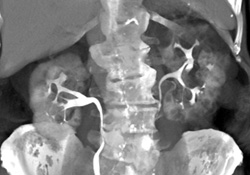 Multiple Cysts Compatible With Polycystic Renal Disease - CTisus CT Scan