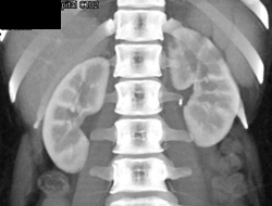 Left Renal Infarcts - CTisus CT Scan