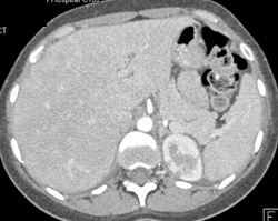 Focal Infarct - CTisus CT Scan