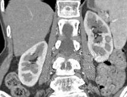 Multiple Left High Density Renal Cysts - CTisus CT Scan