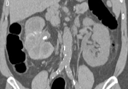 Xanthogranulomatous Pyelonephritis (XGP) Right Kidney - CTisus CT Scan