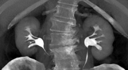 Normal CT Urogram - CTisus CT Scan