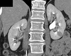 Acute Pyelonephritis - CTisus CT Scan