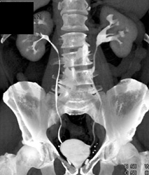 Normal CT Urogram - CTisus CT Scan