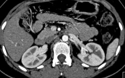 Normal Corticomedullary Phase - CTisus CT Scan