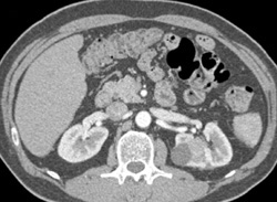 High Density Left Renal Cyst - CTisus CT Scan