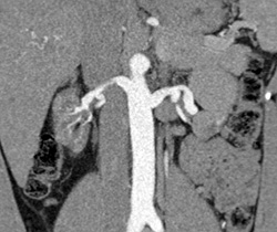 Vasculitis - CTisus CT Scan