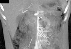 Vasculitis With Collaterals - CTisus CT Scan