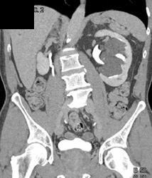 Left Parapelvic Cysts - CTisus CT Scan