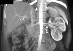 Prior Left Partial Nephrectomies - CTisus CT Scan