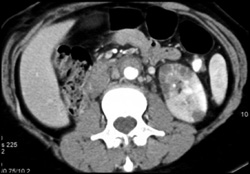 Acute Pyelonephritis - CTisus CT Scan