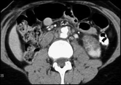 Acute Pyelonephritis - CTisus CT Scan