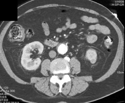 High Density Renal Cyst - CTisus CT Scan