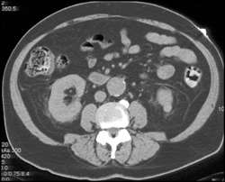 High Density Renal Cyst - CTisus CT Scan