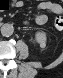 High Density Renal Cyst - CTisus CT Scan