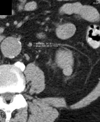 High Density Renal Cyst - CTisus CT Scan