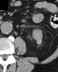 High Density Renal Cyst - CTisus CT Scan