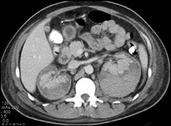 Renal Infarction - CTisus CT Scan