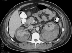 Renal Infarction With Perirenal Bleed - CTisus CT Scan