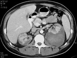 Perirenal Hematomas - CTisus CT Scan