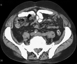 Extramedullary Hematopoiesis With Intradural Disease - CTisus CT Scan