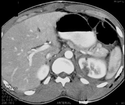 Renal Laceration - CTisus CT Scan