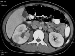 Acute Pyelonephritis - CTisus CT Scan