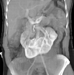 Horseshoe Kidney - CTisus CT Scan