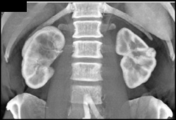 1 Cm Renal Cell Carcinoma - CTisus CT Scan