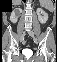 Renal Cell Carcinoma - CTisus CT Scan