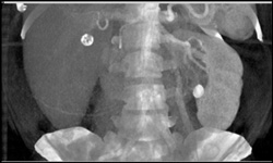 Renal Pelvic Stone - CTisus CT Scan