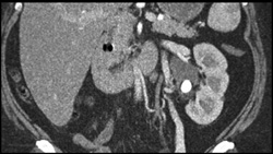 Renal Stone With Hydronephrosis - CTisus CT Scan