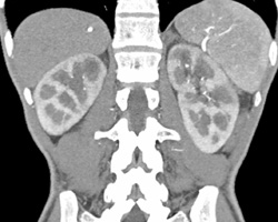 Renal Infarct - CTisus CT Scan