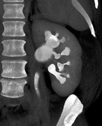 Ct Urogram With Dilated Calyces - CTisus CT Scan