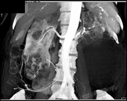 Renal Cell Carcinoma Right Kidney and Polycystic Kidney Disease - CTisus CT Scan